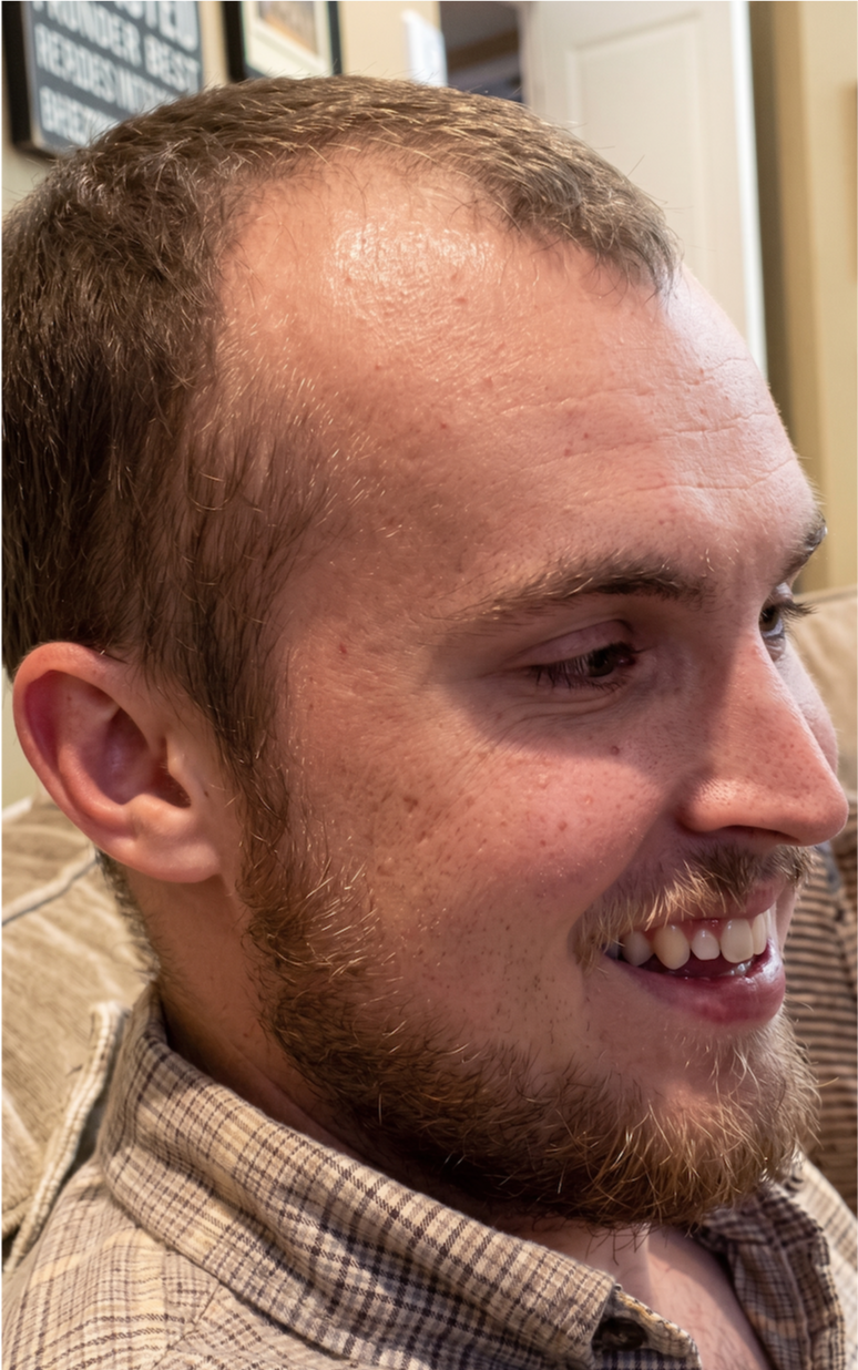 Avery β before, side profile