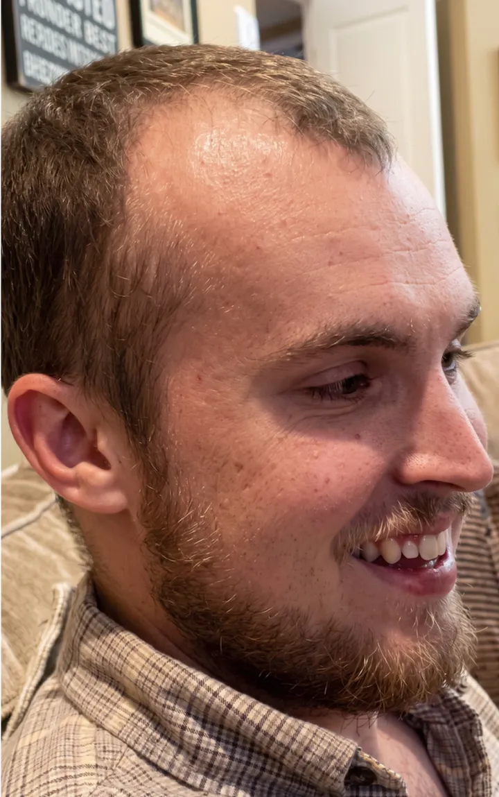 Avery β before, side profile