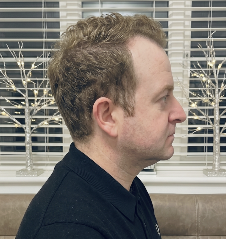 Craig β before, side profile
