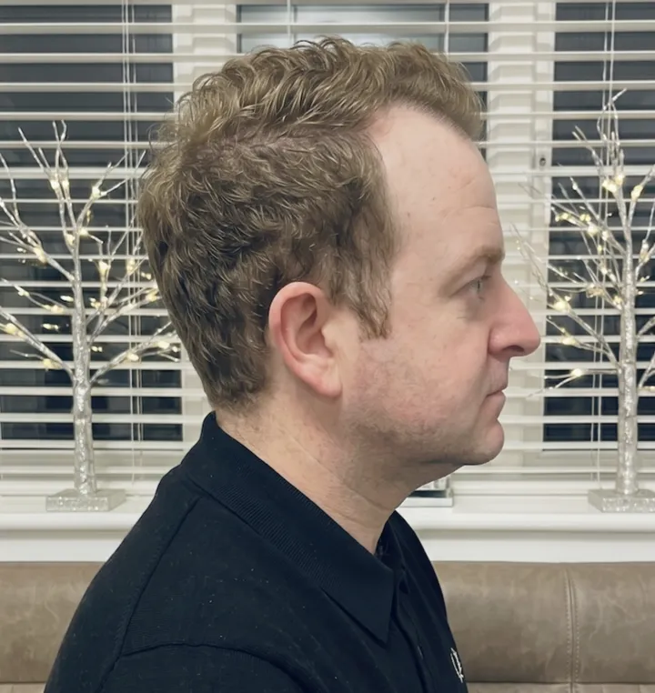 Craig β before, side profile