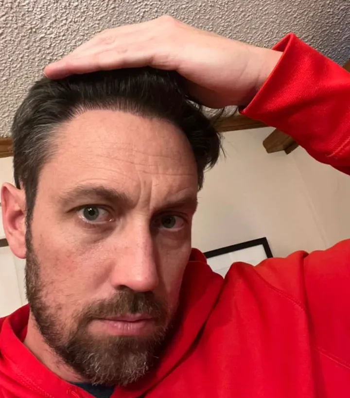 Curtis β after, hairline detail