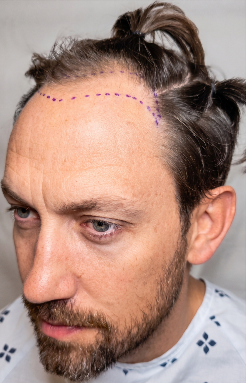 Curtis β before, hairline mapping