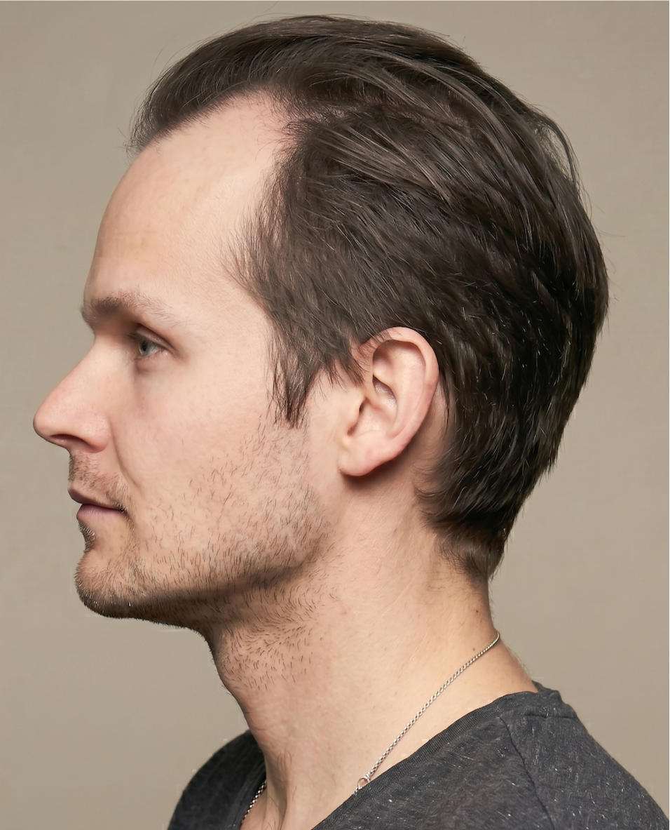 Nick β before, side profile