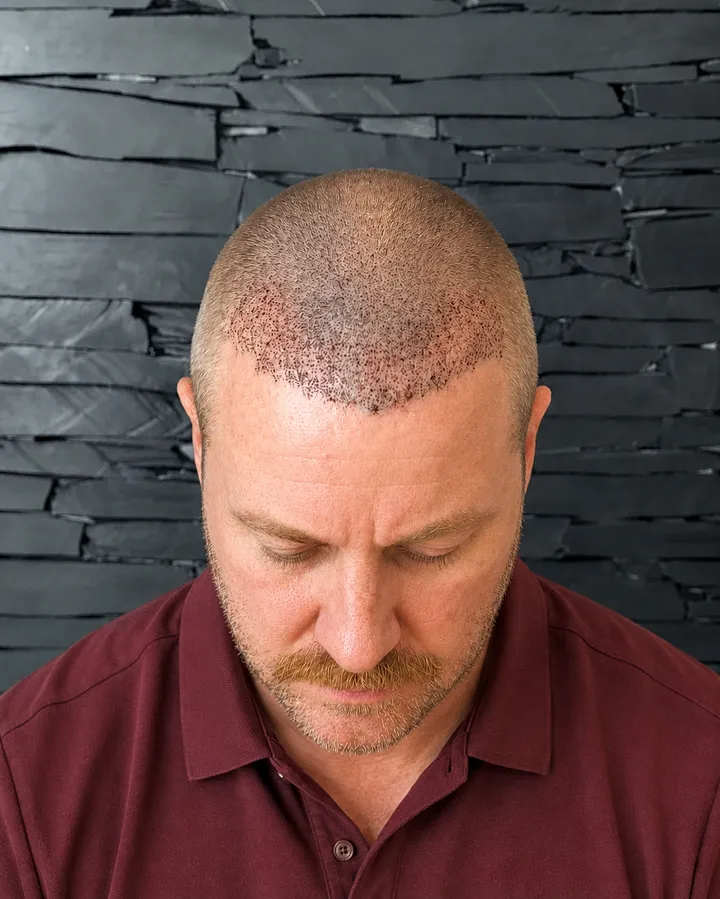 Randy β after, top view